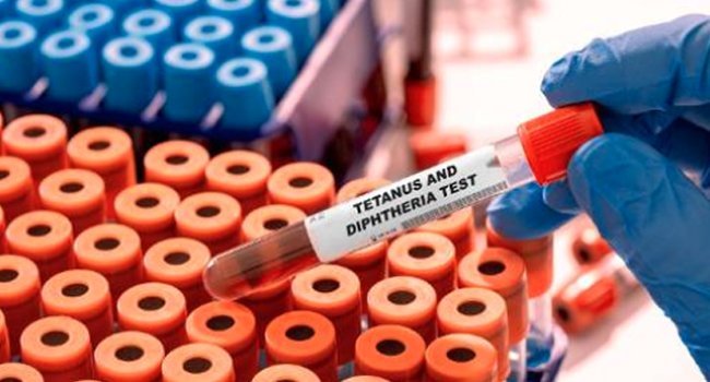 Laboratory sample vial labelled for a diphtheria and tetanus test