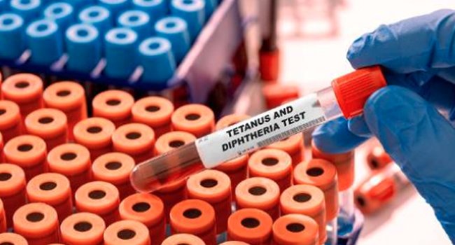 Medical sample labelled tetanus and diphtheria test